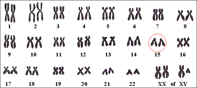 Een persoon met Marfan heeft een Marfan-gen op één of beide chromosomen nr 15.