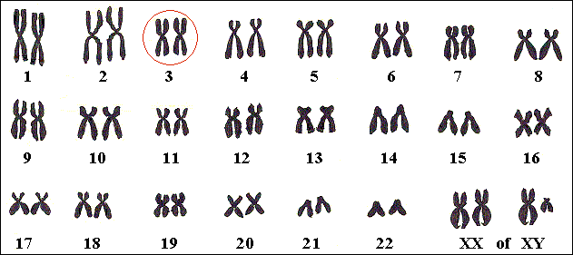 Het gen dat de aanleg voor Von Hippel-Lindau bepaalt, ligt op het derde chromosoom.