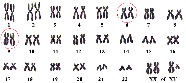 Genen die Carpenter veroorzaken, liggen op chromosomen 6 en 9.