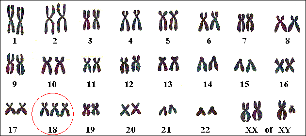 Chromosomenkaart van een persoon met het Edwardssyndroom. Let op het derde chromosoom nr 18.