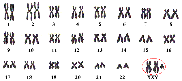 Chromosomenkaart van een jongen met Klinefelter. Meestal is er een extra chromosoom nr 23.