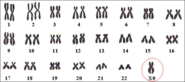 Chromosomenkaart van een meisje met Turner. Let op het eenzame chromosoom nr 23.