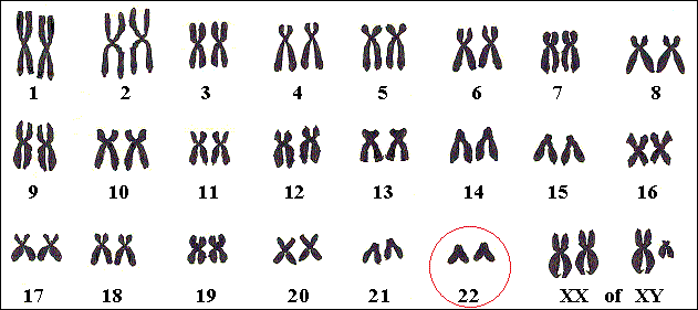 Bij VCFS ontbreekt een stukje van chromosoom 22.